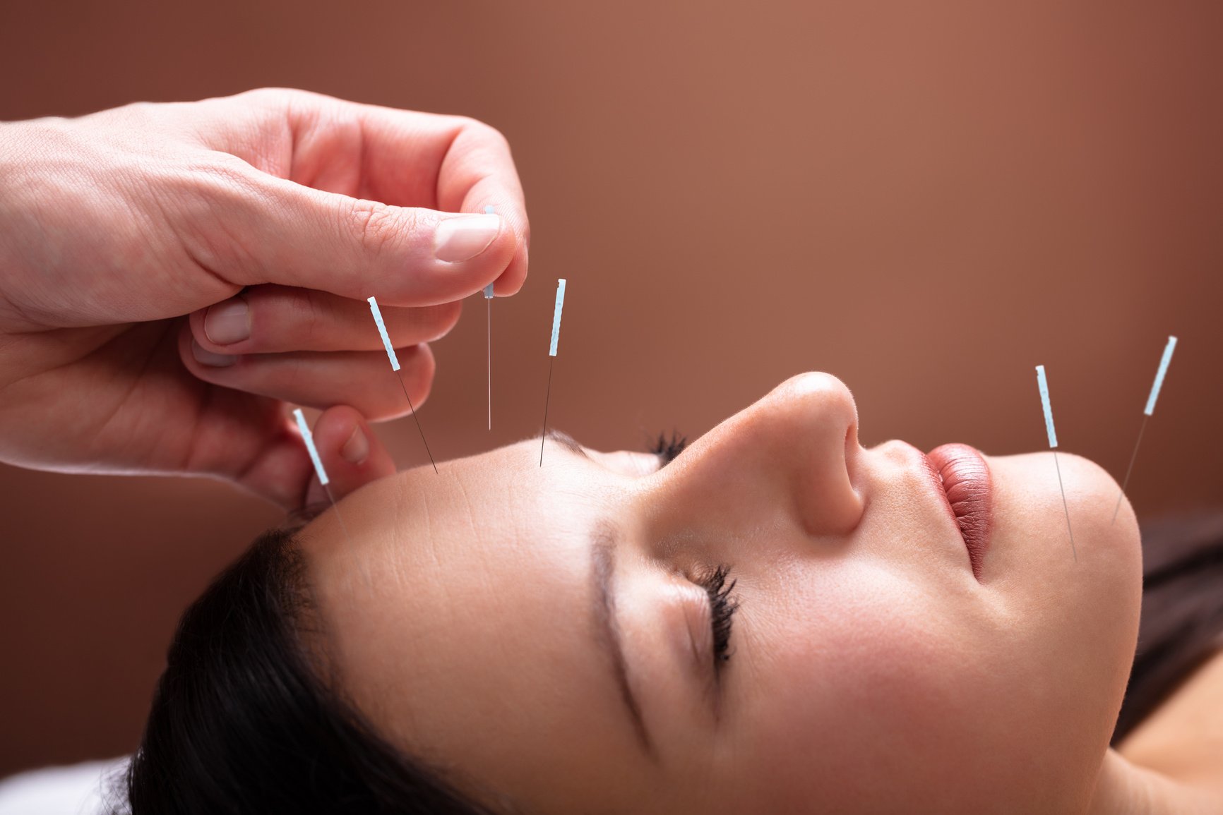 Woman Receiving Acupuncture Treatment On Her Face